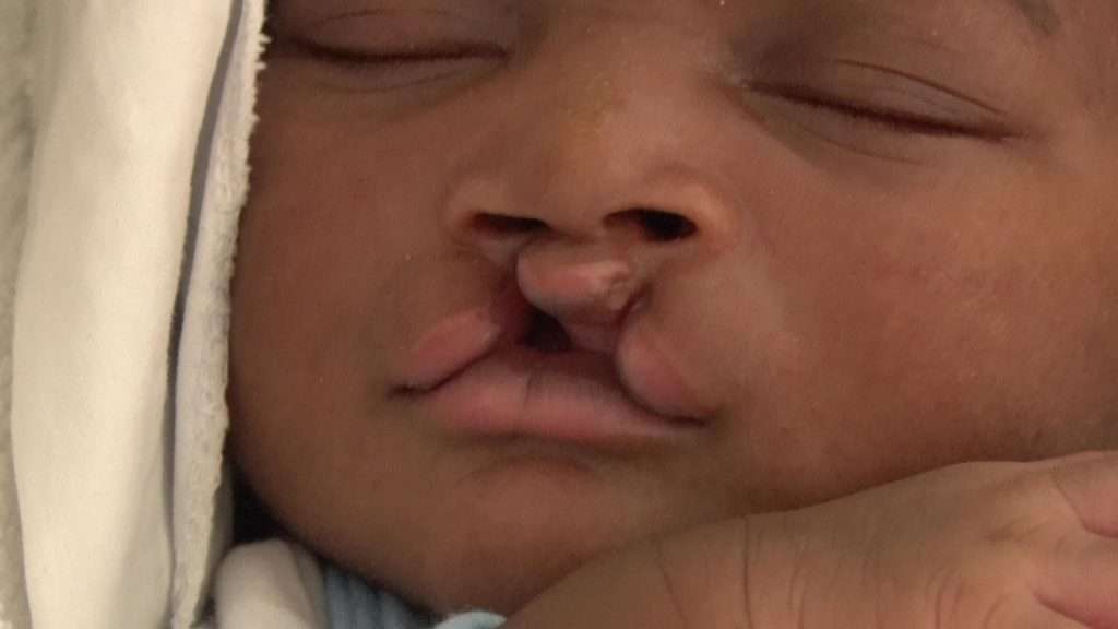 Strong support system needed for mothers with cleft lip babies
