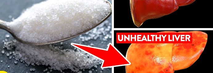 What Sugar Does to Your Liver
